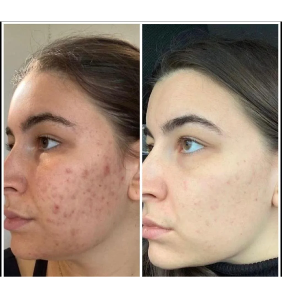 Before and after of a skin treatment
