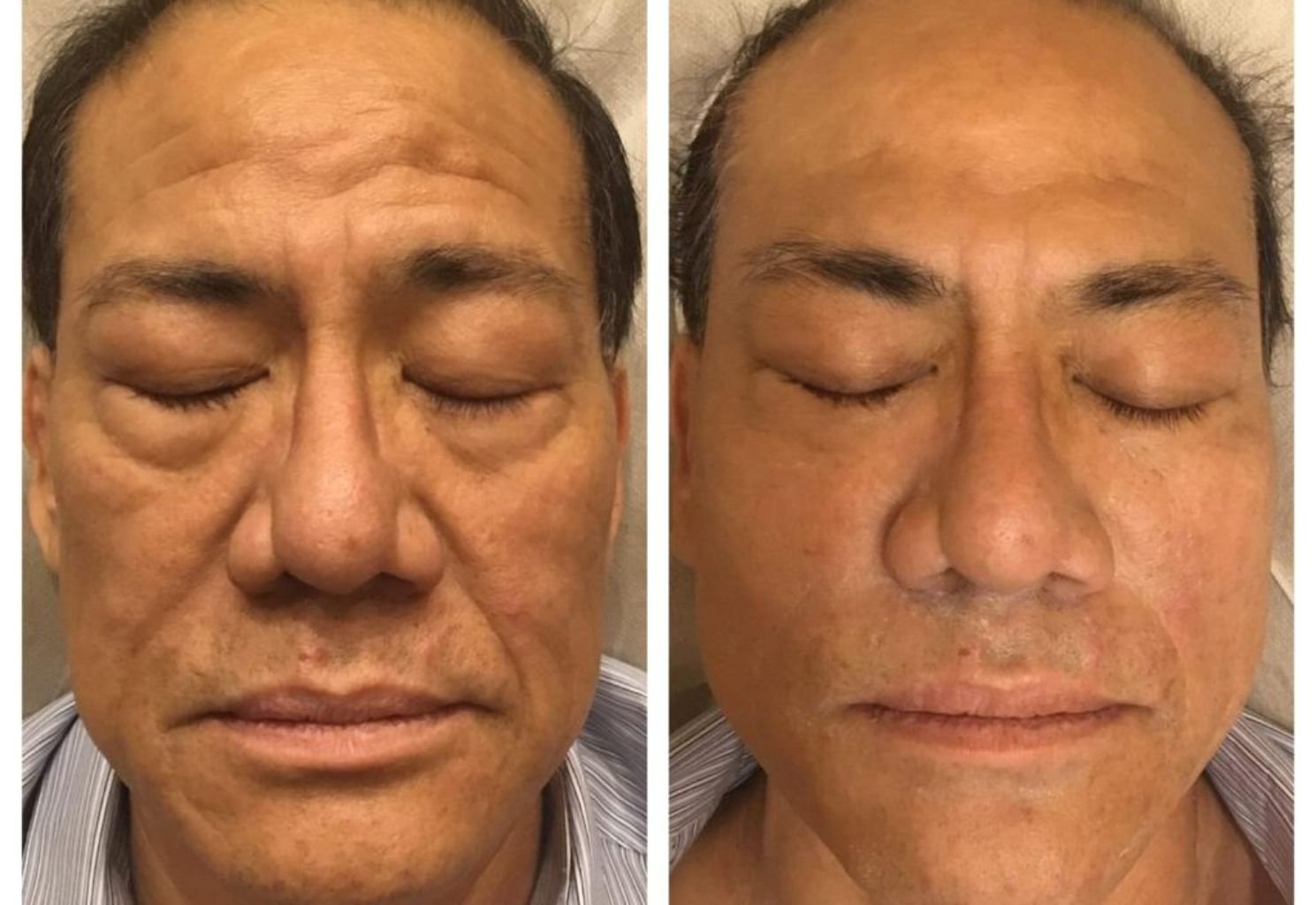 Before and after of a skin treatment