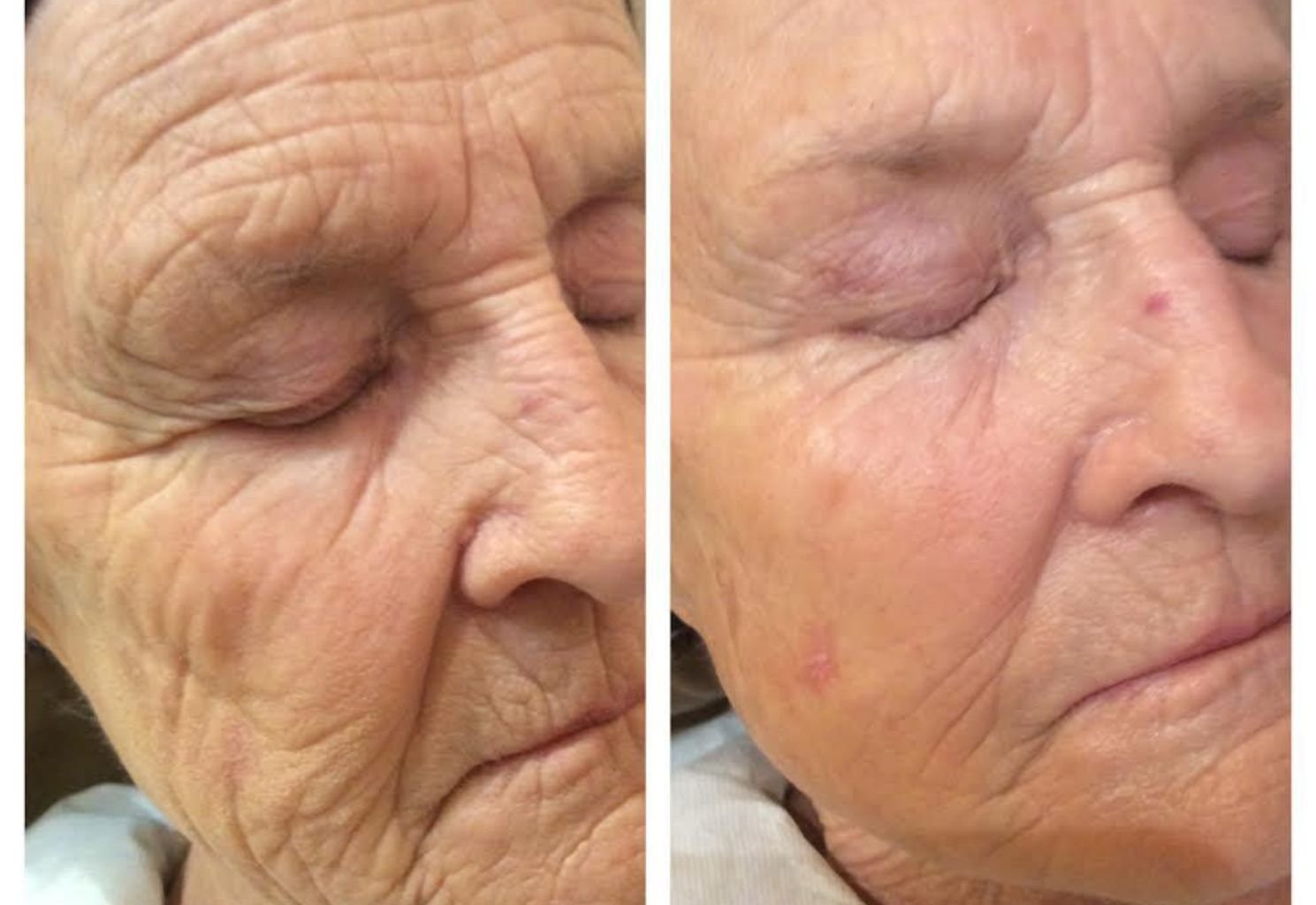 Before and after of a skin treatment