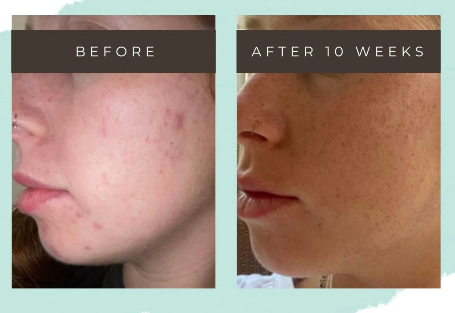 Before and after of a skin treatment