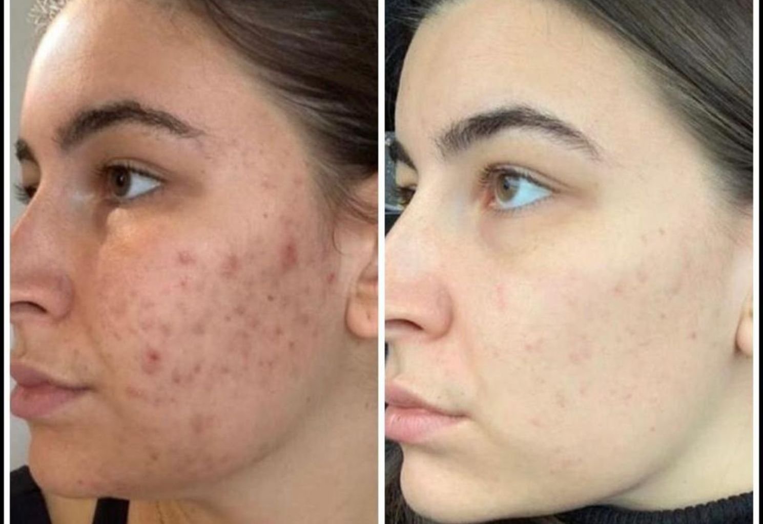 Before and after of a skin treatment